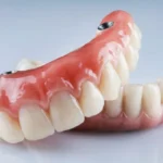 Quality Tooth Replacement Options That Fit Your Budget