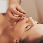 Acupuncture