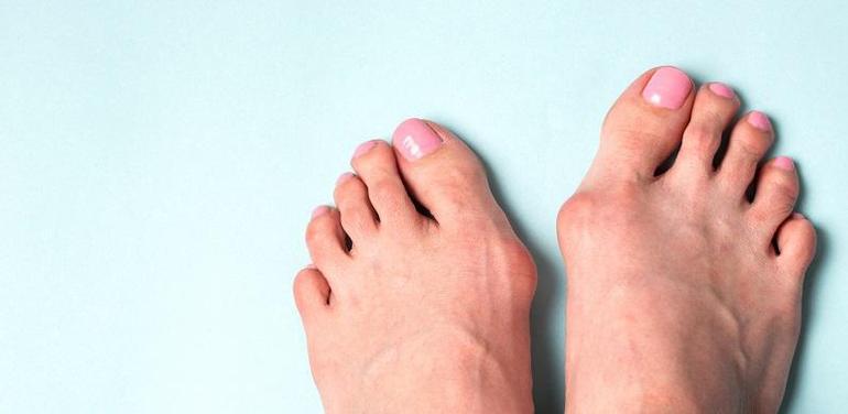 Treating Bunions